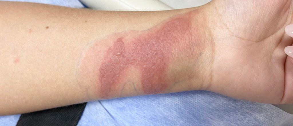 Imagem mostra mancha eritematosa dolorosa, linear e bem definida, com múltiplas pequenas vesículas no pulso esquerdo de uma jovem que teve contato com inseto tóxico e que causa celulite infecciosa