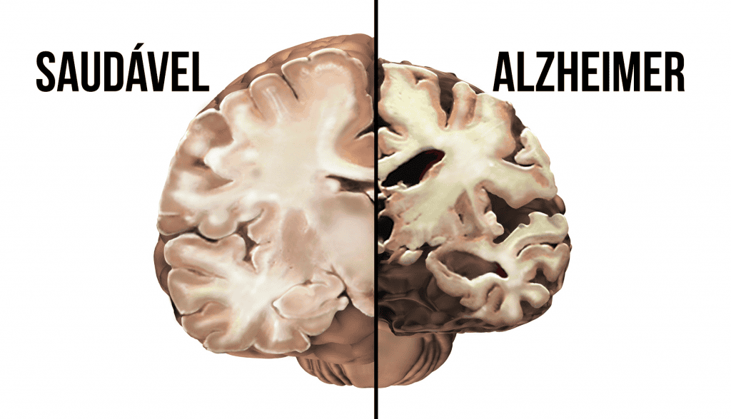 imagem mostra uma montagem que comparece um cérebro saudável com aquele que possui alzheimer