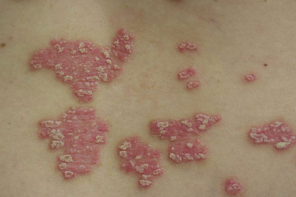Imagem mostra placas cutâneas em um paciente com psoríase