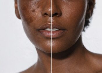 Vai o verão, ficam as manchas. E aí?