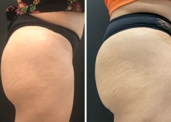 “Bumbum de colágeno”: glúteos podem envelhecer sem perder volume